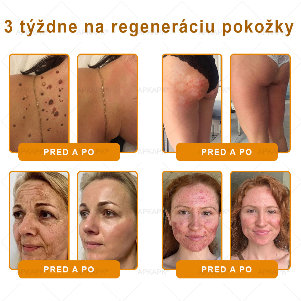 𝖠𝖯𝖪𝖠𝖯𝖪® 🐝🐝 Krém s včelím jedem na obnovu pokožky 🐝 pomáha pri riešení kožných problémov, ako sú: vrásky, jazvy, pigmentové škvrny, strie, akné, psoriáza, ekzém, kožné lézie, podráždenia, zápaly a ďalšie kožné problémy.