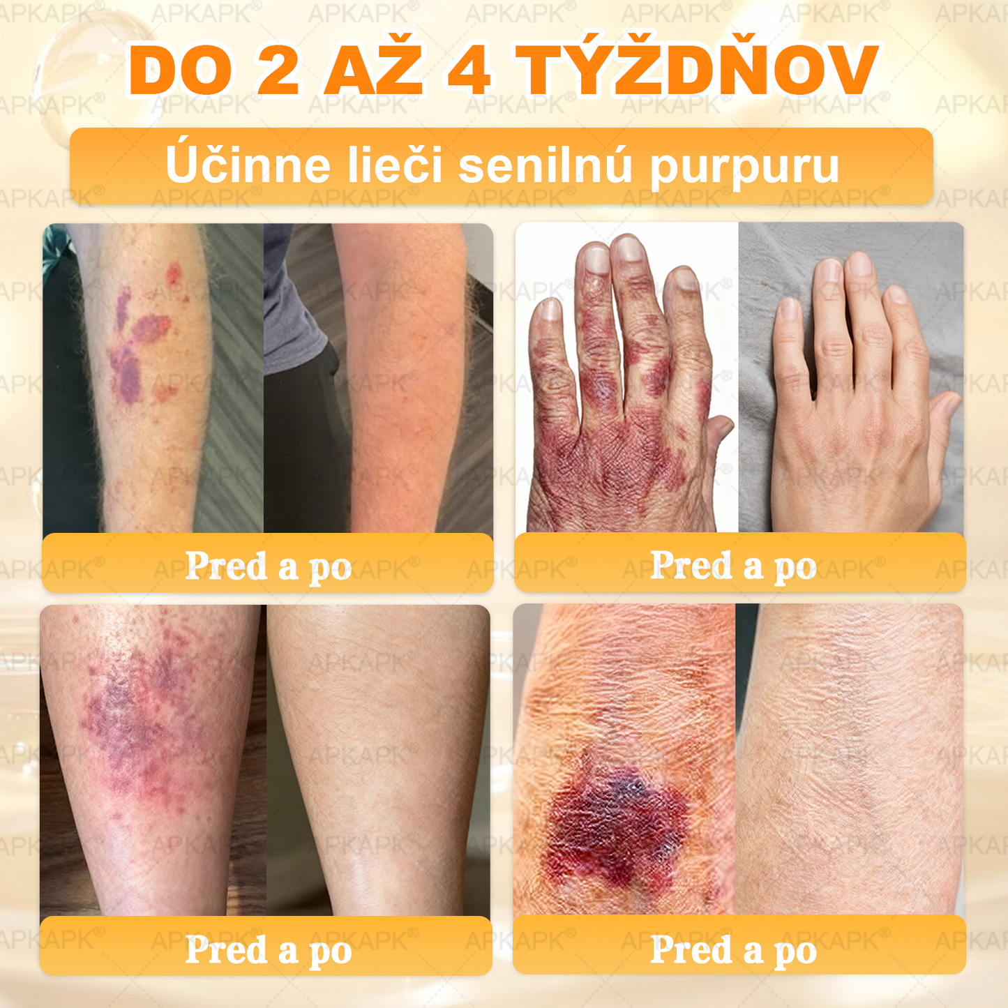 𝖠𝖯𝖪𝖠𝖯𝖪® 🐝🐝 Krém s včelím jedem na obnovu pokožky 🐝 pomáha pri riešení kožných problémov, ako sú: vrásky, jazvy, pigmentové škvrny, strie, akné, psoriáza, ekzém, kožné lézie, podráždenia, zápaly a ďalšie kožné problémy.