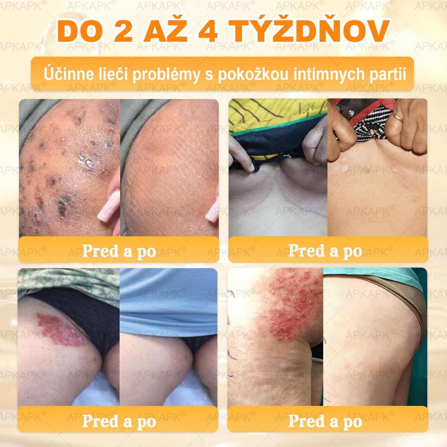 𝖠𝖯𝖪𝖠𝖯𝖪® 🐝🐝 Krém s včelím jedem na obnovu pokožky 🐝 pomáha pri riešení kožných problémov, ako sú: vrásky, jazvy, pigmentové škvrny, strie, akné, psoriáza, ekzém, kožné lézie, podráždenia, zápaly a ďalšie kožné problémy.