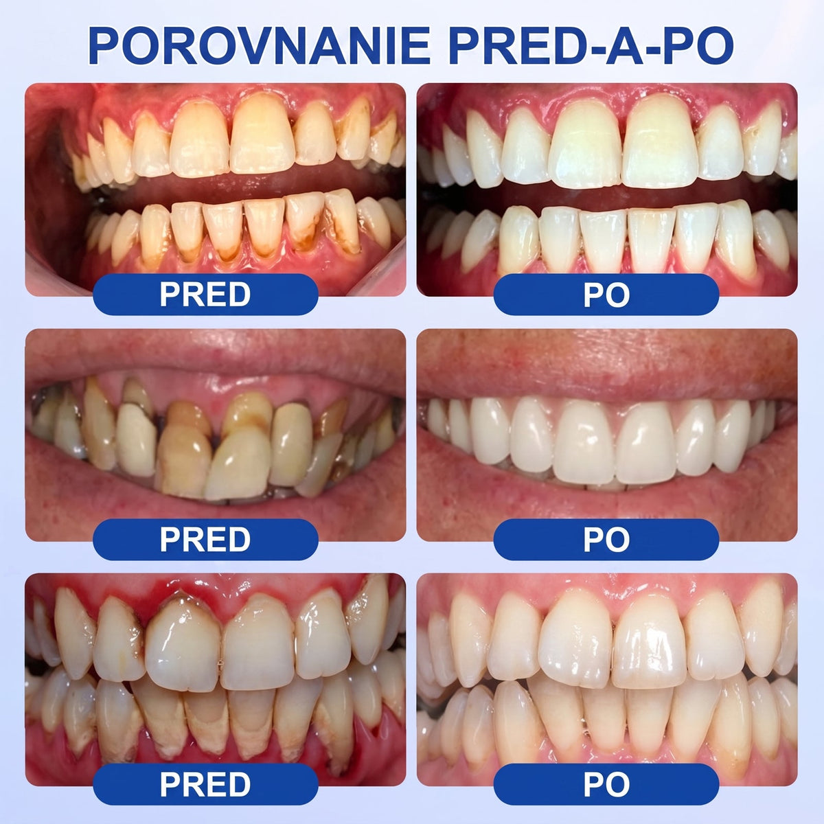 Prelomové klinické riešenie na regeneráciu ústnej dutiny 👨‍⚕️🦷 PureShade® GumRevive regeneračný gél na parodont🎁