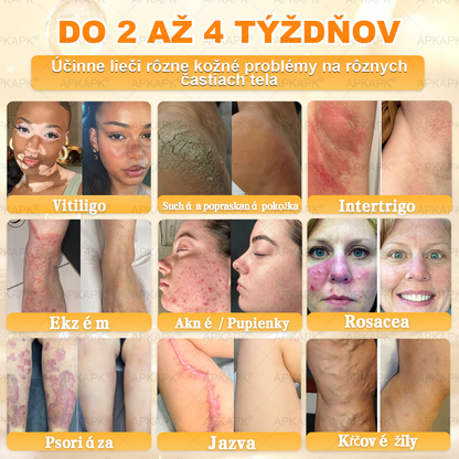 𝖠𝖯𝖪𝖠𝖯𝖪® 🐝🐝 Krém s včelím jedem na obnovu pokožky 🐝 pomáha pri riešení kožných problémov, ako sú: vrásky, jazvy, pigmentové škvrny, strie, akné, psoriáza, ekzém, kožné lézie, podráždenia, zápaly a ďalšie kožné problémy.