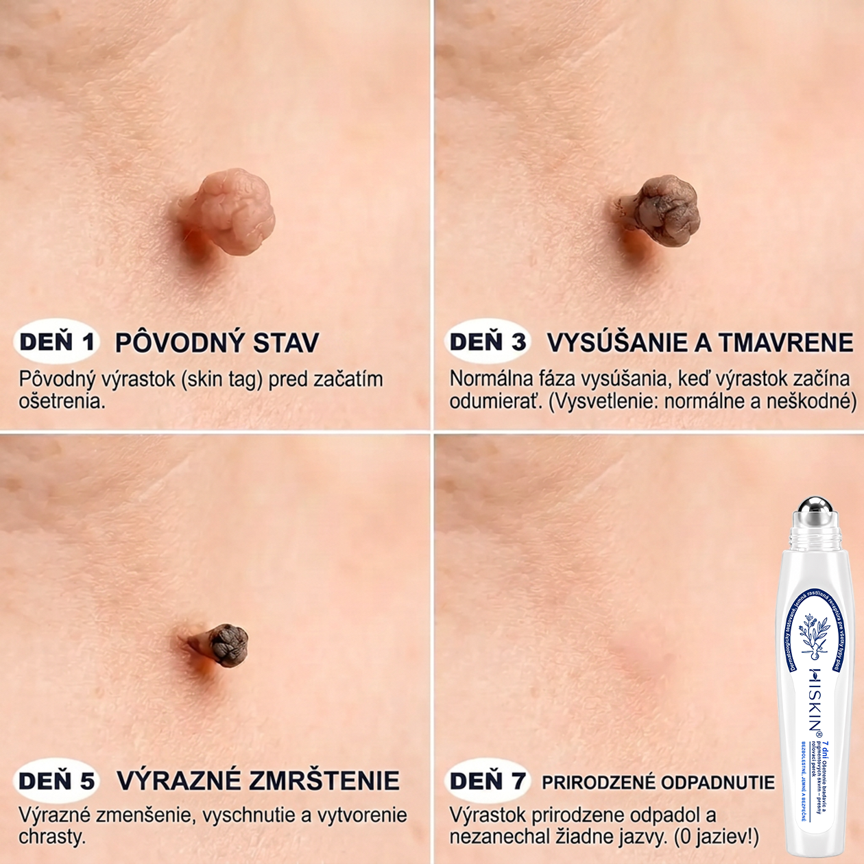 𝑶𝒇𝒊𝒄𝒊á𝒍𝒏𝒚 𝒐𝒃𝒄𝒉𝒐𝒅 ✅️👨‍⚕️| 𝐇𝐈𝐒𝐊𝐈𝐍® 7-𝒅ň𝒐𝒗ý 𝒑𝒓í𝒑𝒓𝒂𝒗𝒐𝒌 𝒏𝒂 𝒐𝒅𝒔𝒕𝒓á𝒏𝒆𝒏𝒊𝒆 𝒌𝒐ž𝒏ý𝒄𝒉 𝒗ý𝒓𝒂𝒔𝒕𝒌𝒐𝒗 𝒂 𝒑𝒊𝒈𝒎𝒆𝒏𝒕𝒐𝒗ý𝒄𝒉 š𝒌𝒗ŕ𝒏👩‍⚕️ (𝒃𝒆𝒛 𝒃𝒐𝒍𝒆𝒔𝒕𝒊, 𝒃𝒆𝒛 𝒋𝒂𝒛𝒊𝒆𝒗, 𝒑𝒓𝒆𝒔𝒏ý 𝒓𝒐𝒍𝒍-𝒐𝒏 𝒂𝒑𝒍𝒊𝒌á𝒕𝒐𝒓) 🔥