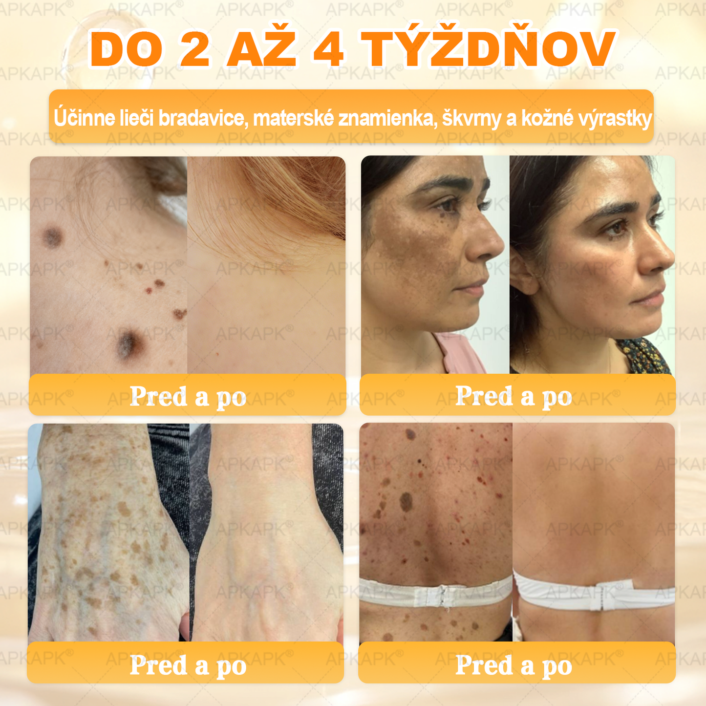 𝖠𝖯𝖪𝖠𝖯𝖪® 🐝🐝 Krém s včelím jedem na obnovu pokožky 🐝 pomáha pri riešení kožných problémov, ako sú: vrásky, jazvy, pigmentové škvrny, strie, akné, psoriáza, ekzém, kožné lézie, podráždenia, zápaly a ďalšie kožné problémy.