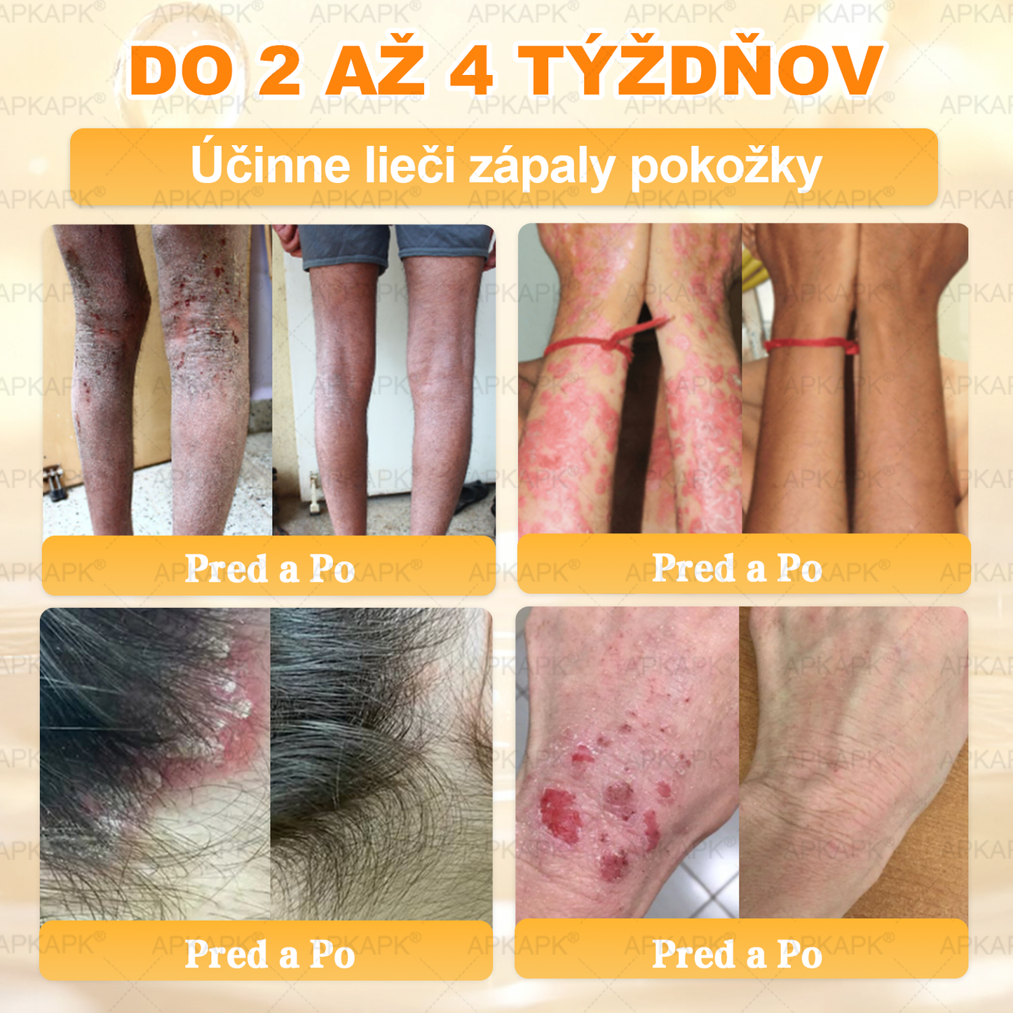 𝖠𝖯𝖪𝖠𝖯𝖪® 🐝🐝 Krém s včelím jedem na obnovu pokožky 🐝 pomáha pri riešení kožných problémov, ako sú: vrásky, jazvy, pigmentové škvrny, strie, akné, psoriáza, ekzém, kožné lézie, podráždenia, zápaly a ďalšie kožné problémy.